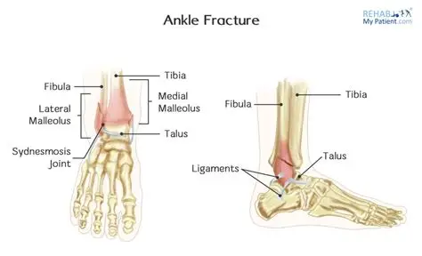 Ankle Fracture