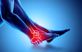 Ankle Sprain