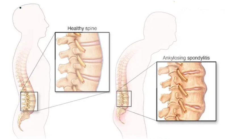 Ankylosing Spondylitis