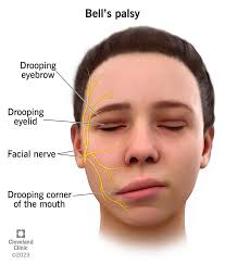 Bell's Palsy Or Facial Palsy