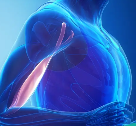 Biceps Tendonitis