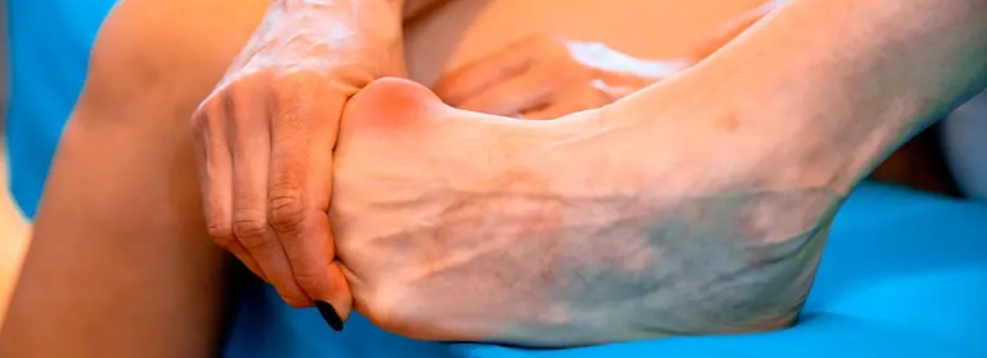 Bunion Or Hallux Valgus
