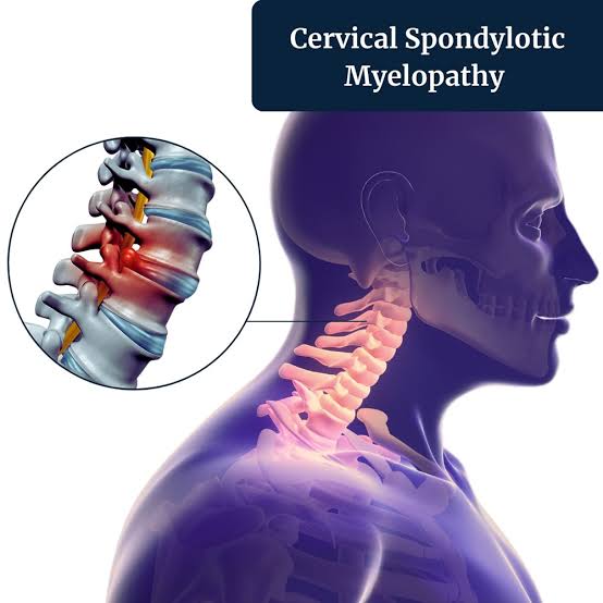 Cervical Myelopathy