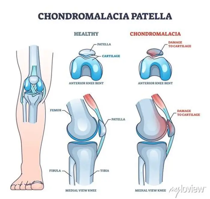 Chondromalacia Patella