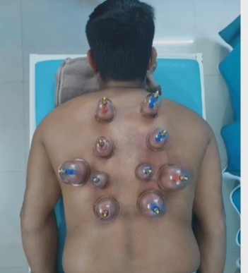 Cupping Therapy