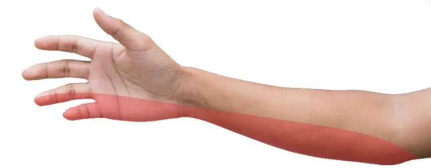 Cubital Tunnel Syndrome