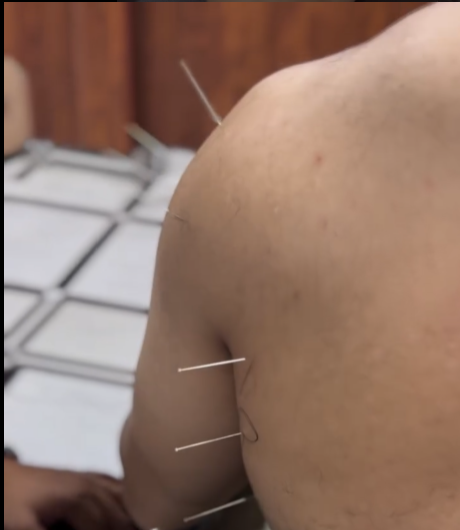 Dry Needling Therapy