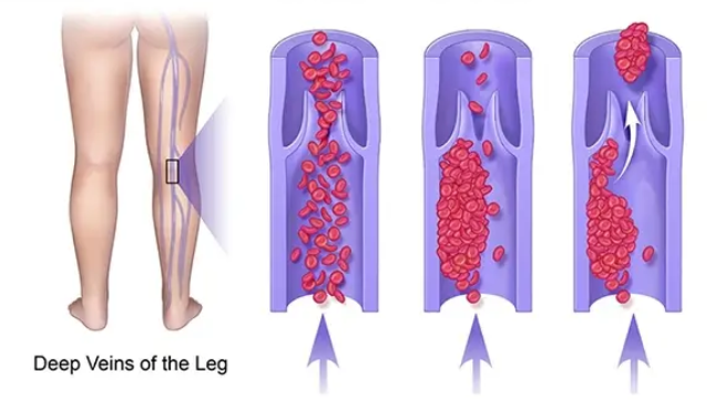 Deep Venous Thrombosis