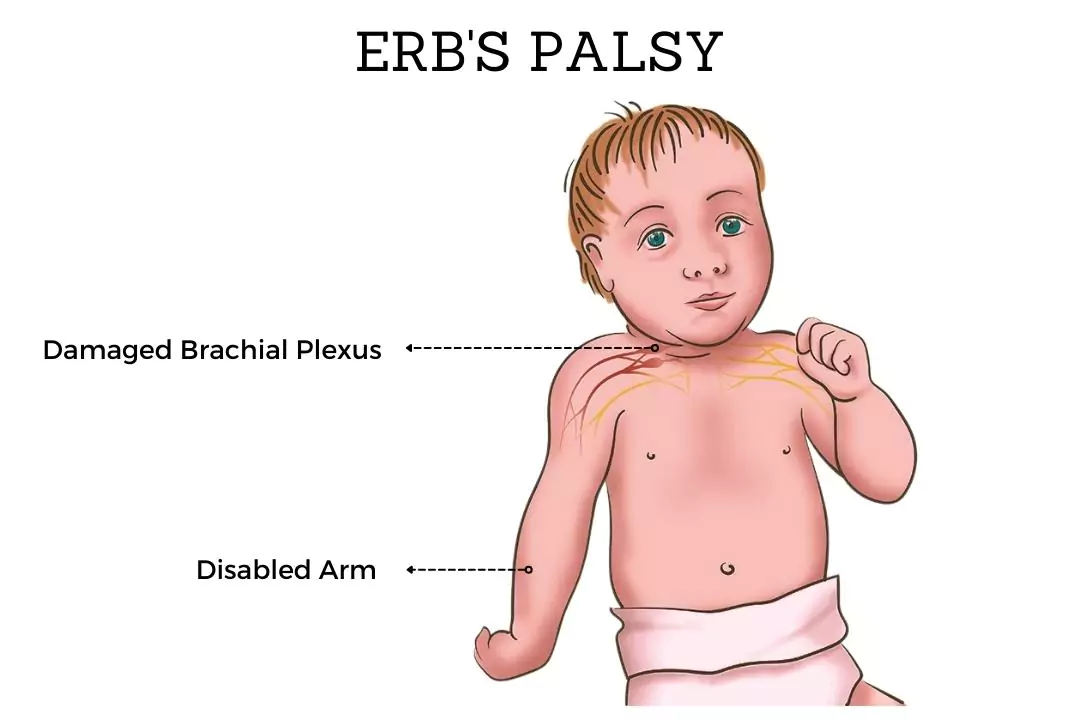 Erb’s Palsy