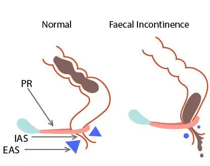 Fecal Incontinence