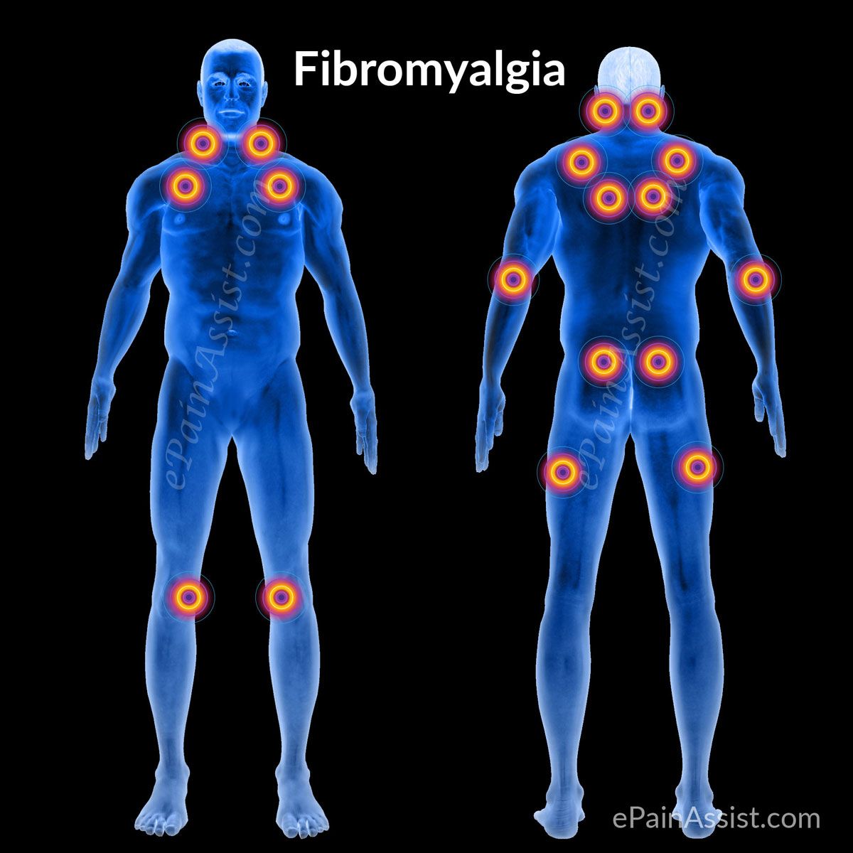 Fibromyalgia Syndrome