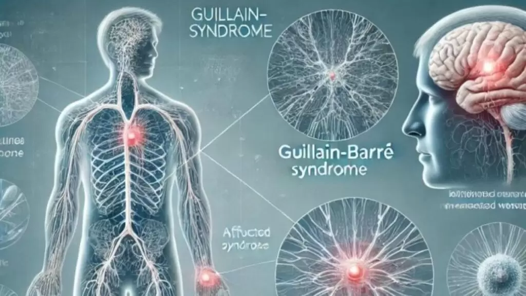 Guillain-barré Syndrome