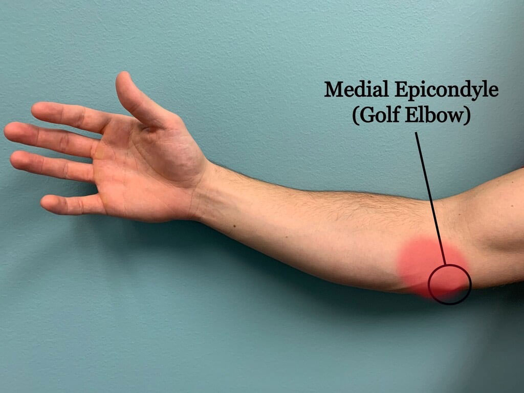 Golfer's Elbow