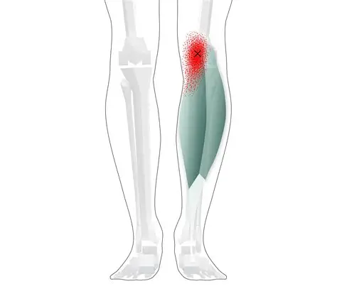 Gastrocnemius Rupture