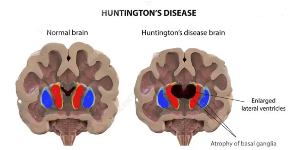 Huntington's Disease