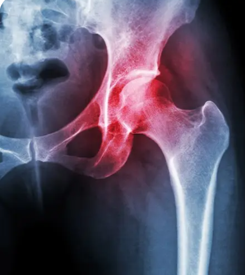 Hip Impingement