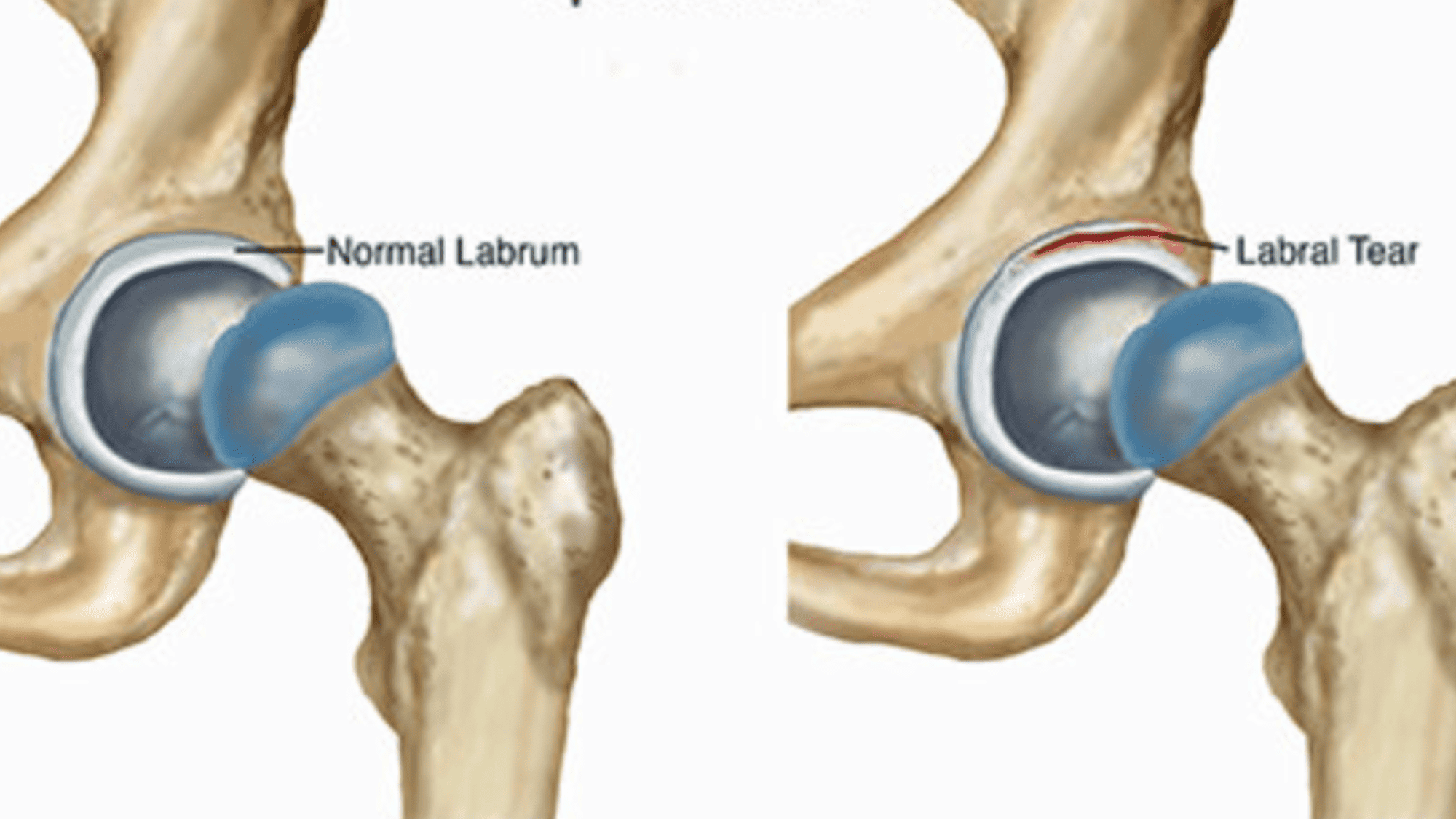 Hip Labral Tear