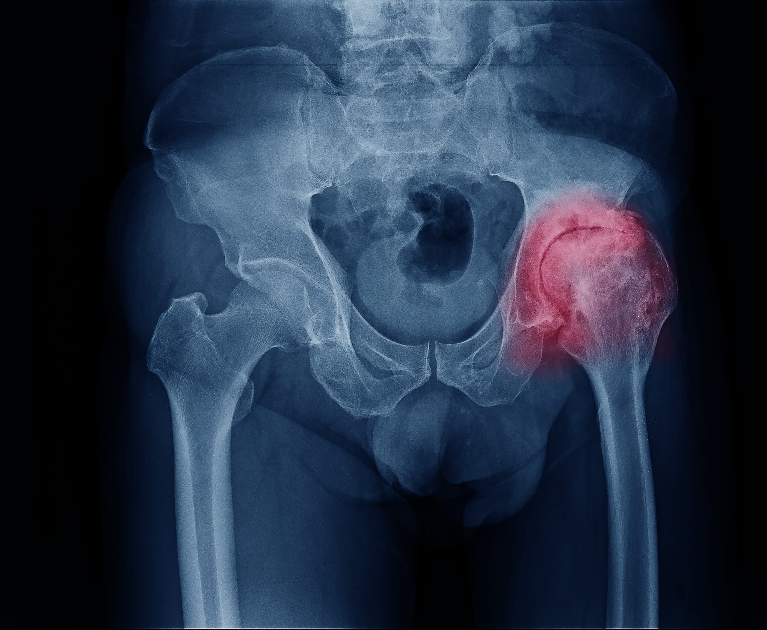 Hip Osteoarthritis