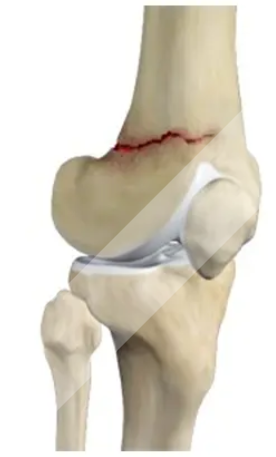 Knee Fracture