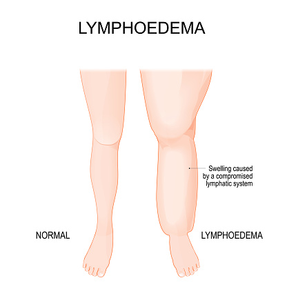 Lymphedema