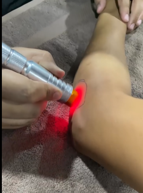 Laser Therapy