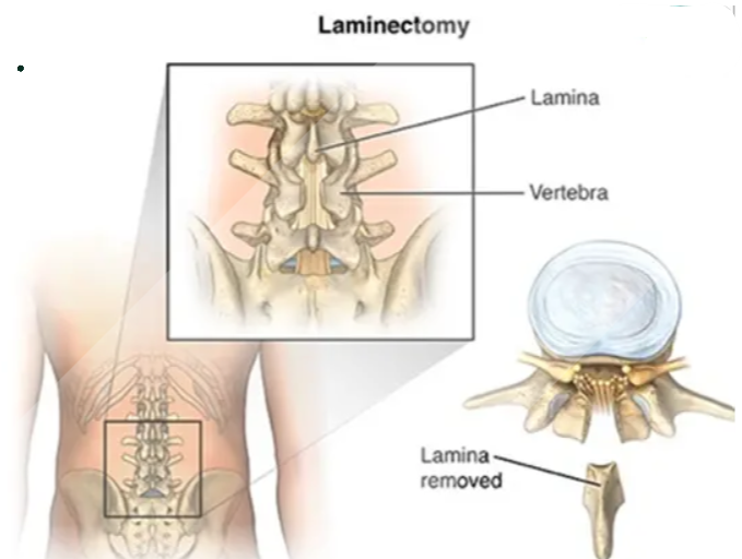Laminectomy