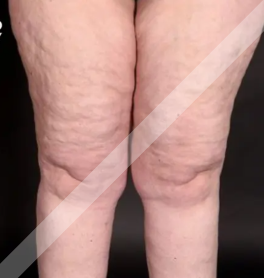 Lipedema