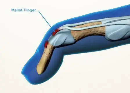 Mallet Finger