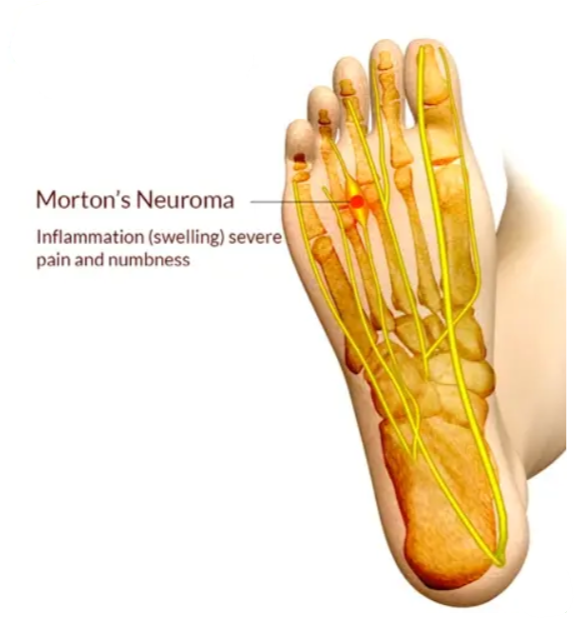 Morton's Neuroma