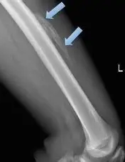 Myositis Ossification