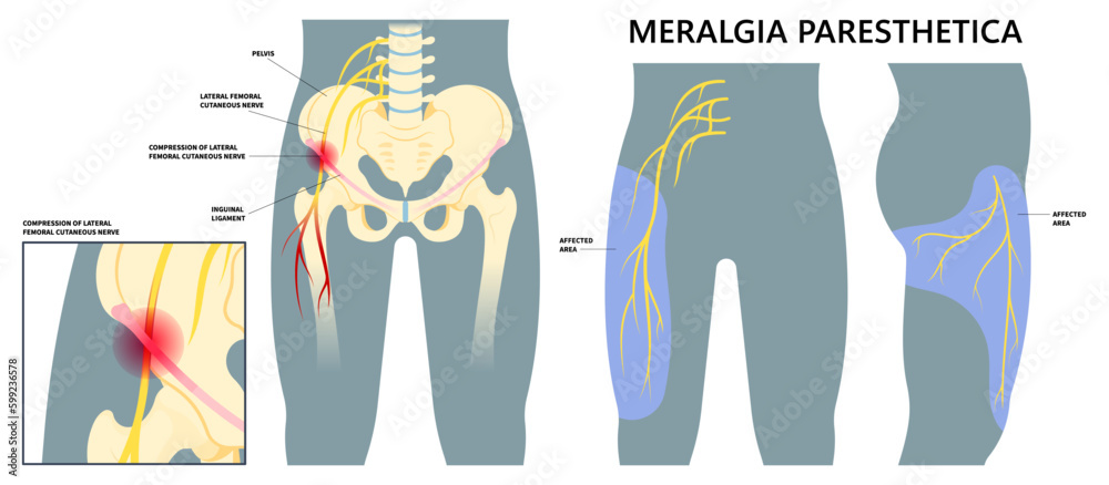 Meralgia Paresthetica