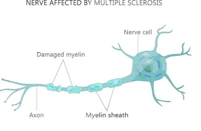 Multiple Sclerosis