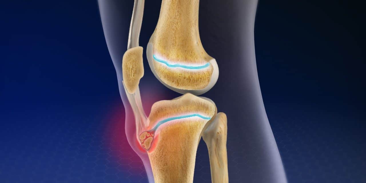 Osgood-schlatter Disease