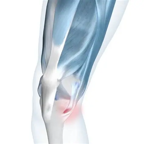 Pes Anserine Bursitis
