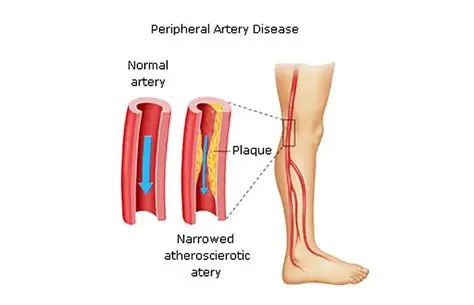 Peripheral Artery Disease
