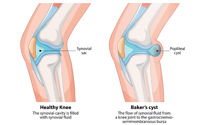 Popliteal (baker's) Cyst