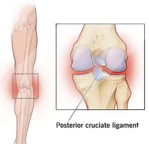 Posterior Cruciate Ligament Injury