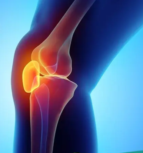 Patella Dislocation