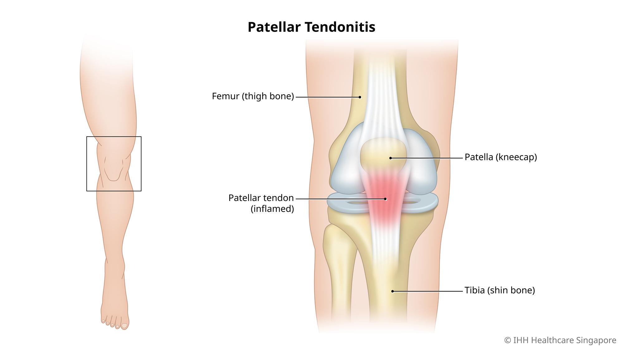 Patellar Tendonitis
