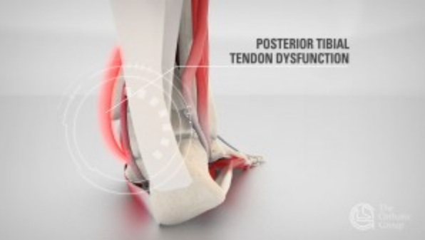 Posterior Tibial Tendon Dysfunction