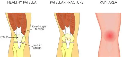Patellar Fracture