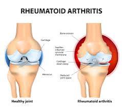 Rheumatoid Arthritis