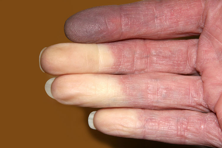 Raynaud’s Disease