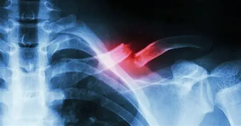 Shoulder And Arm Fractures