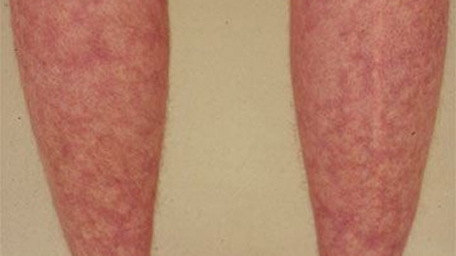 Systemic Lupus Erythematosus
