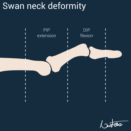 Swan Neck Deformity