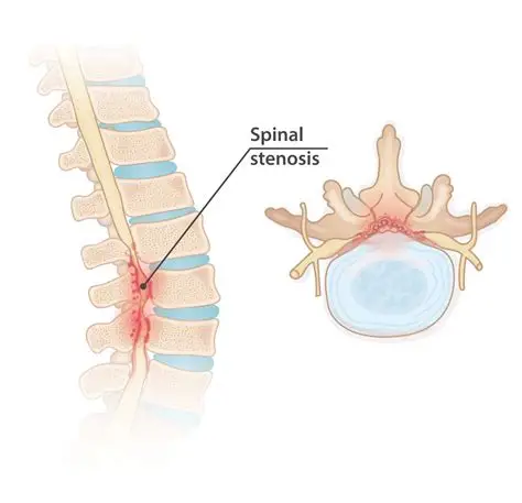 Spinal Stenosis