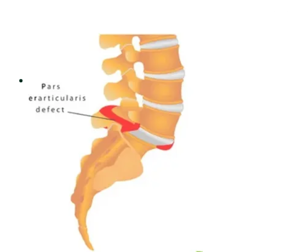 Spondylolisthesis