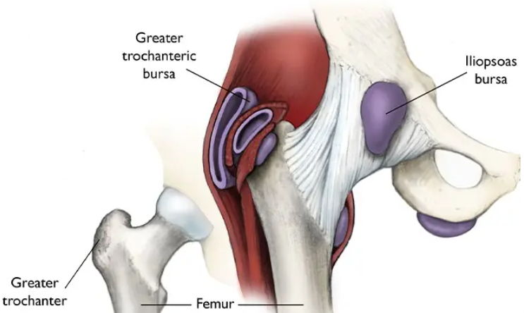 Trochanteric Bursitis