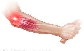 Tennis Elbow